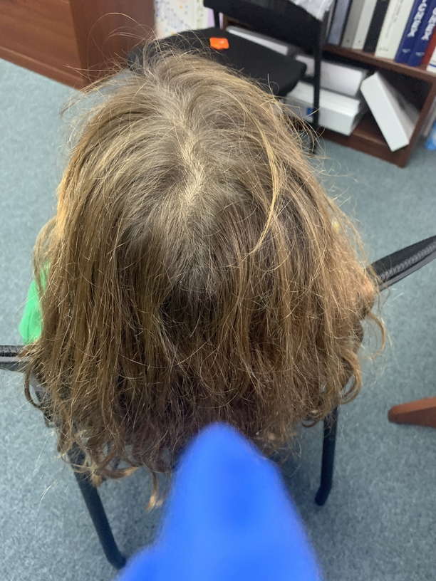 Newport News, Virginia Lice Treatment & Lice Removal Service LiceDoctors